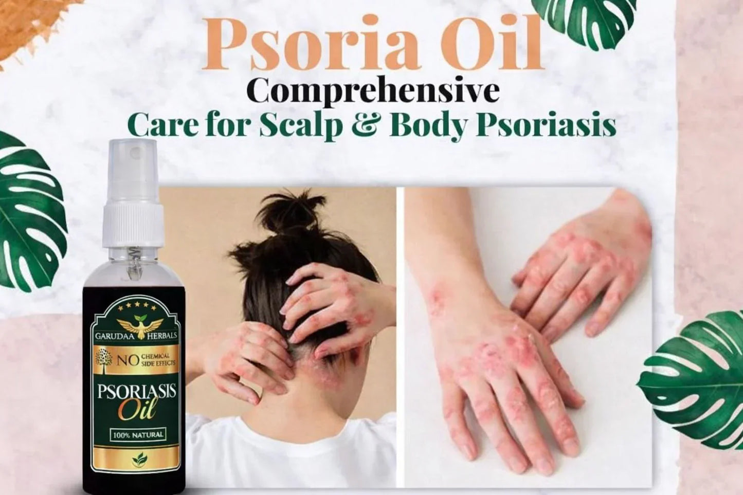 Soriasis Oil & Medicine -(SRI LANKA)