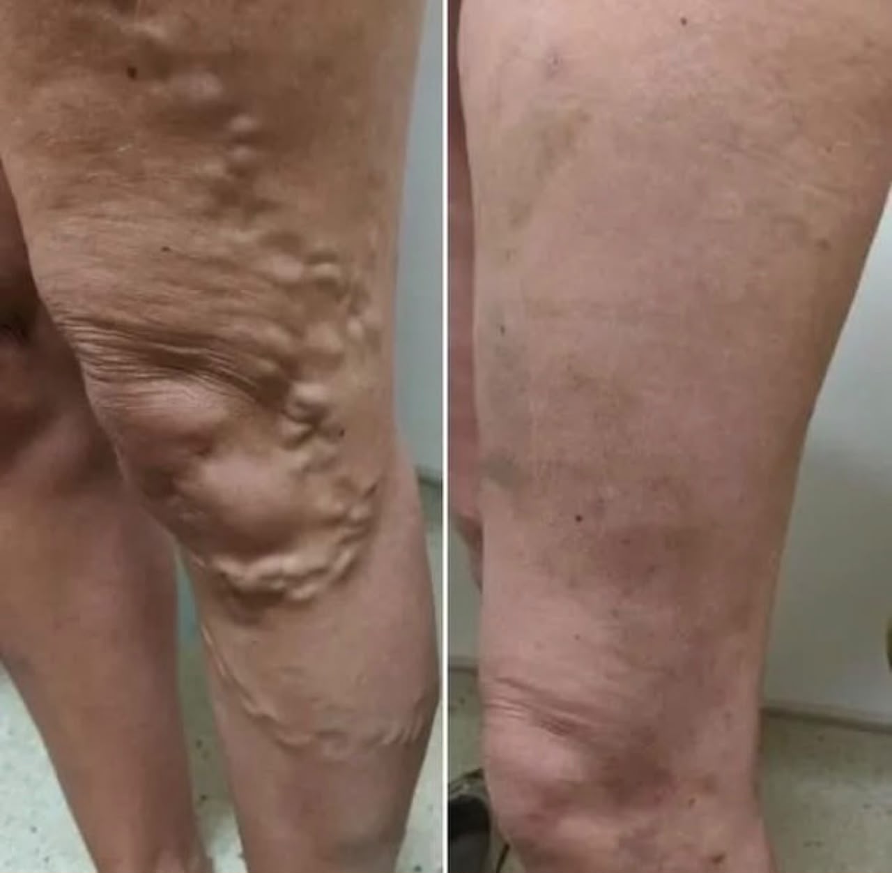 VARICOSE VEINS PAIN RELIEF OIL