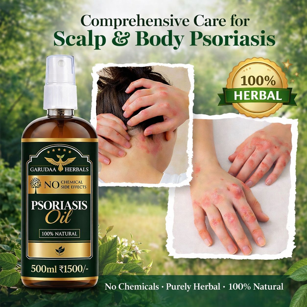 Garuda Herbal Psoriasis Oil-Advanced Psoriasis Clearing Oil